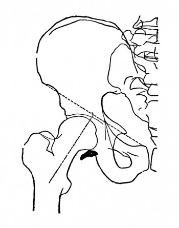 Проекция тазобедренного сустава по схеме с рентгенограммы
