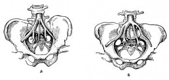 Различия в строении брюшной аорты