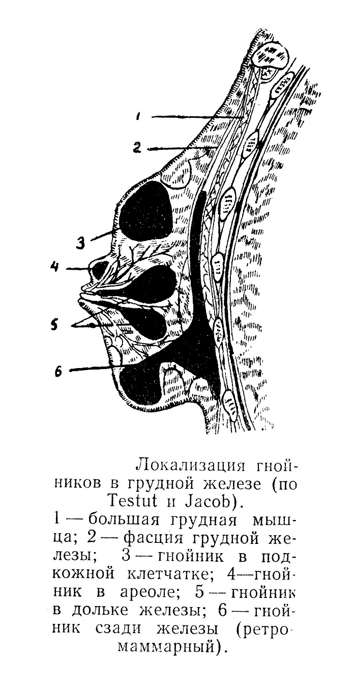 Локализация гнойников в грудной железе (по Testut и Jacob).