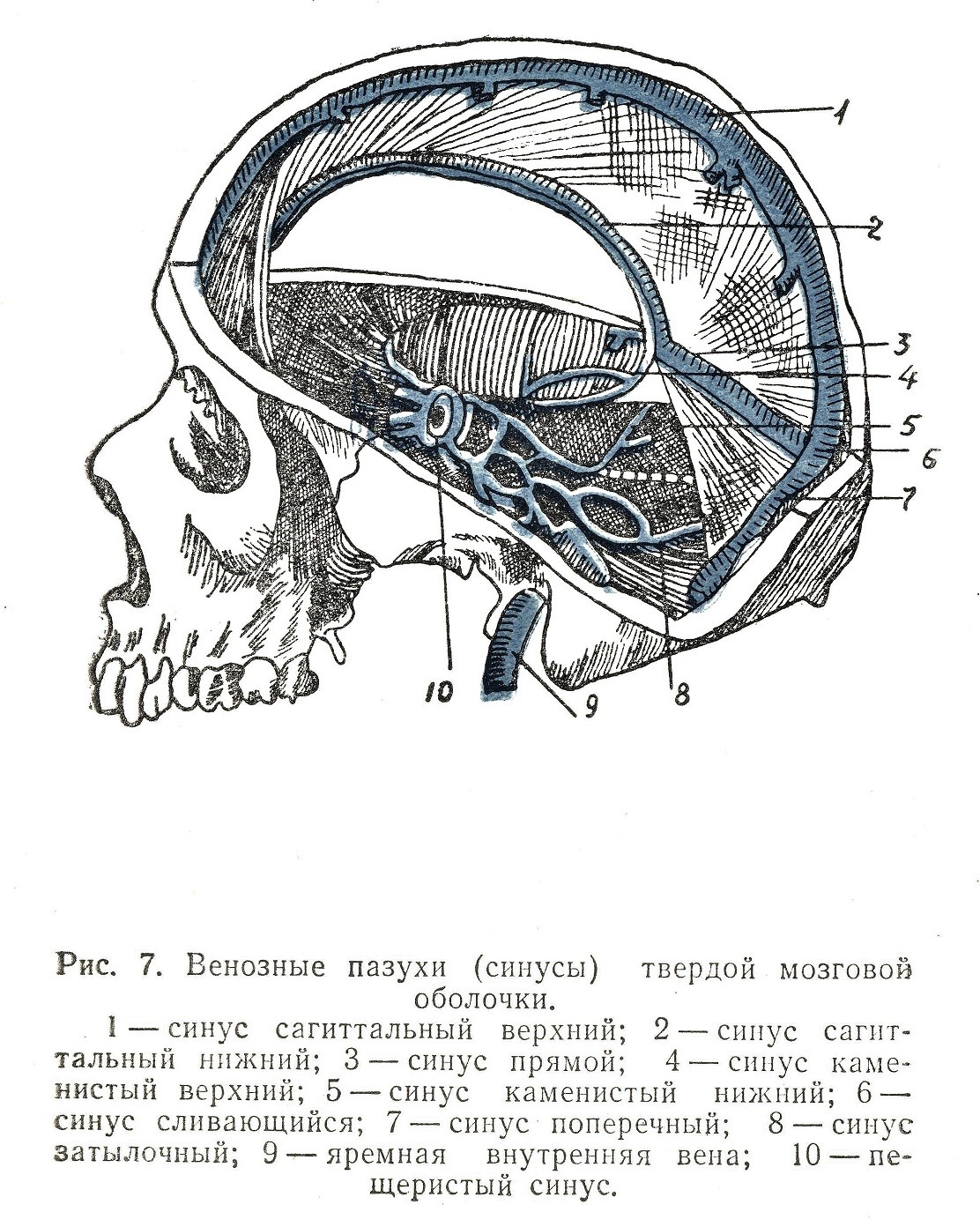 Синусы оболочки головного мозга. Синусы твёрдой мозговой оболочки анатомия. Синусы твердой мозговой оболочки на черепе. Синусы твердой мозговой оболочки схема. Сигмовидный синус твердой мозговой оболочки.