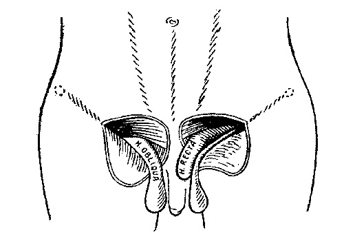 Наружная косая грыжа — hernia inguinalis lateralis (externa) s. obliqua