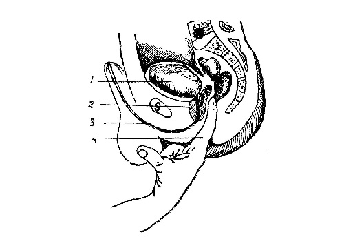 Предстательная железа - glandula prostata - мужские половые органы