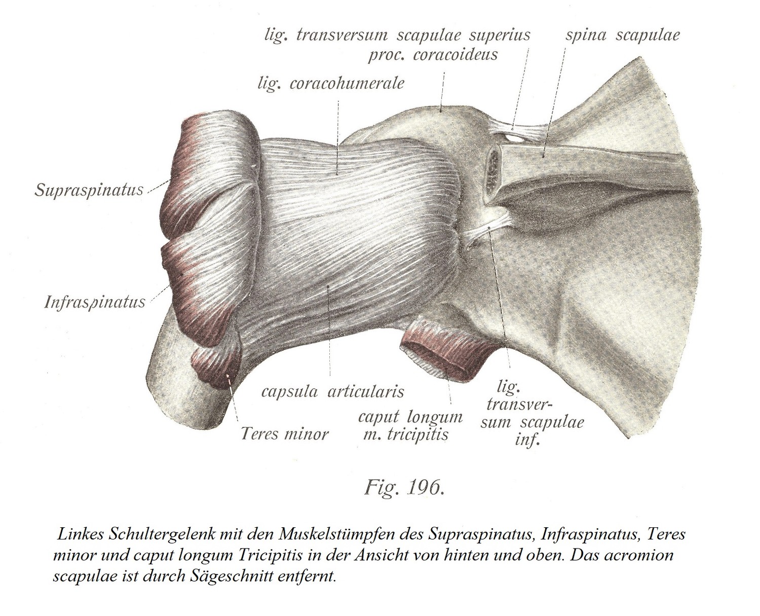 Левый плечевой сустав с культями надостной, подостной, малой круглой и длинной трехглавой мышцы, вид сзади и сверху. Акромиальный отросток лопатки удален пильным разрезом.