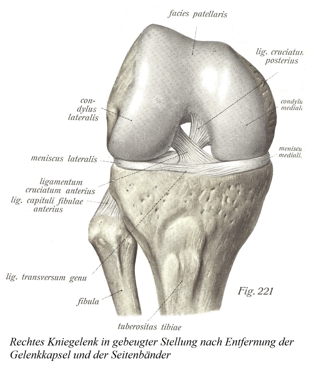 Правый коленный сустав в согнутом положении после удаления суставной капсулы и боковых связок