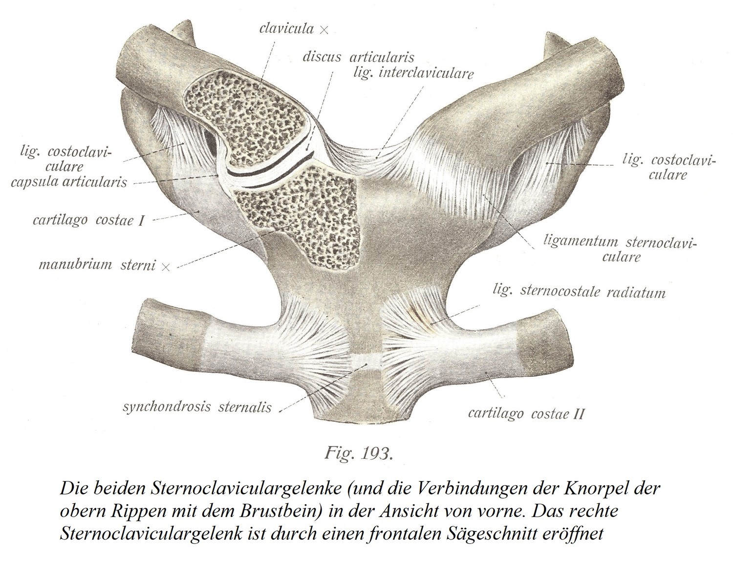 Два грудино-ключичных сустава (и соединения хрящей верхних ребер с грудиной) в виде спереди. Правый грудино-ключичный сустав вскрывают лобной пилой.