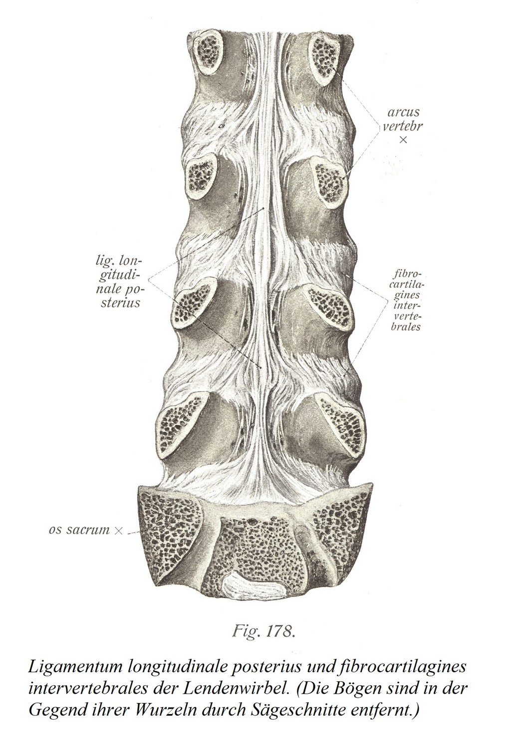 Задняя продольная связка и межпозвонковые волокнистые хрящи поясничных позвонков. (Своды удаляются спилами в области их корней.)
