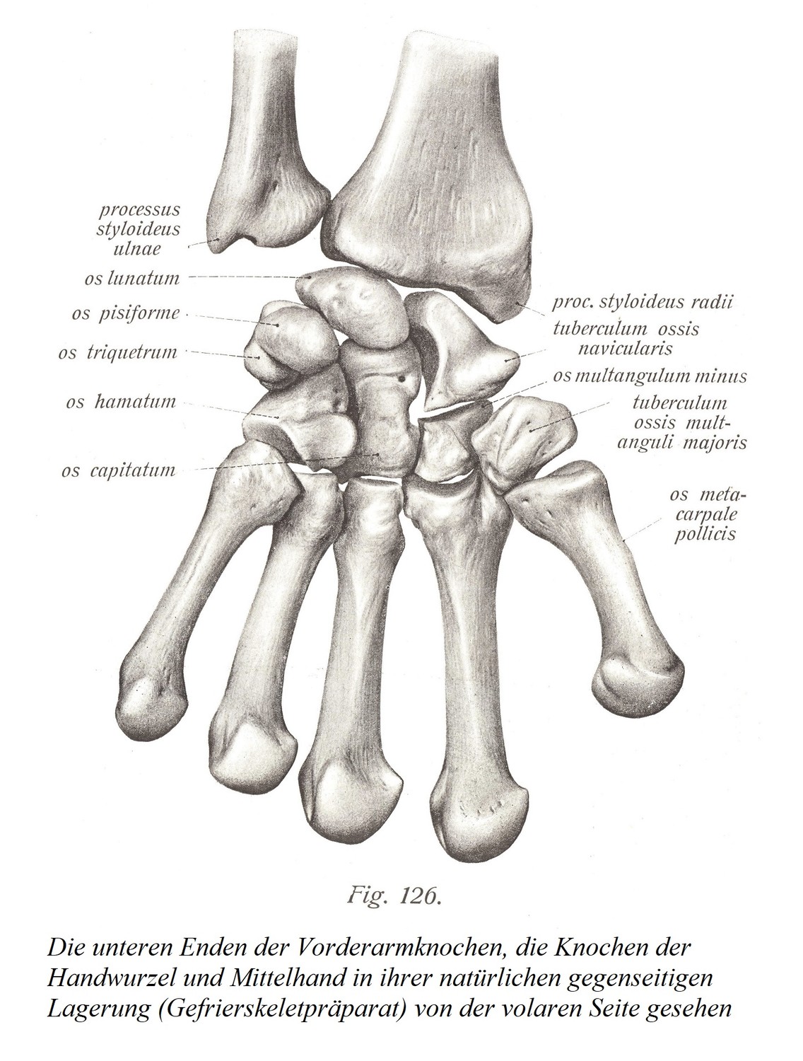 Нижние концы костей предплечья, кости запястья и пястные кости в их естественном взаимном положении (препарат замороженного скелета) при осмотре с ладонной стороны