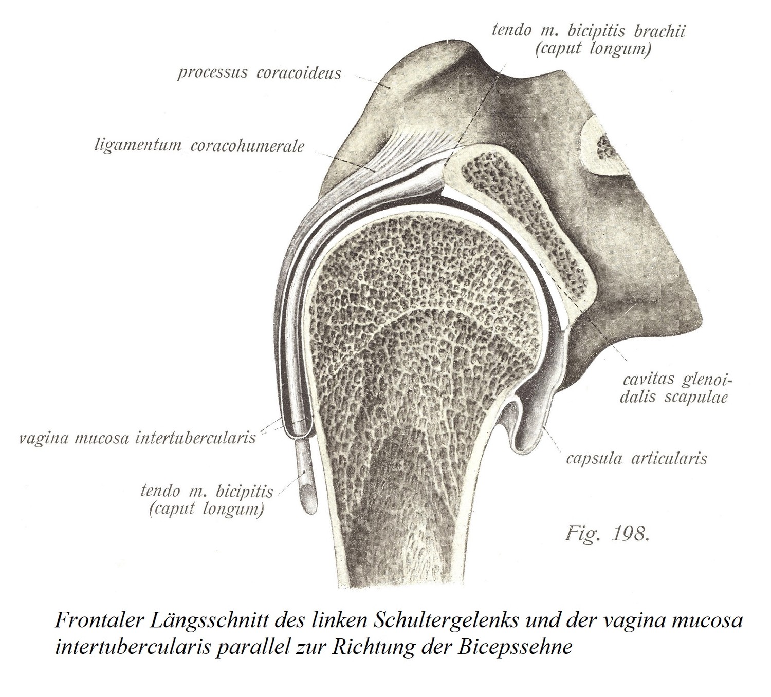 Фронтальный продольный разрез левого плечевого сустава и слизистой оболочки межбугоркового влагалища параллельно направлению сухожилия двуглавой мышцы плеча. 