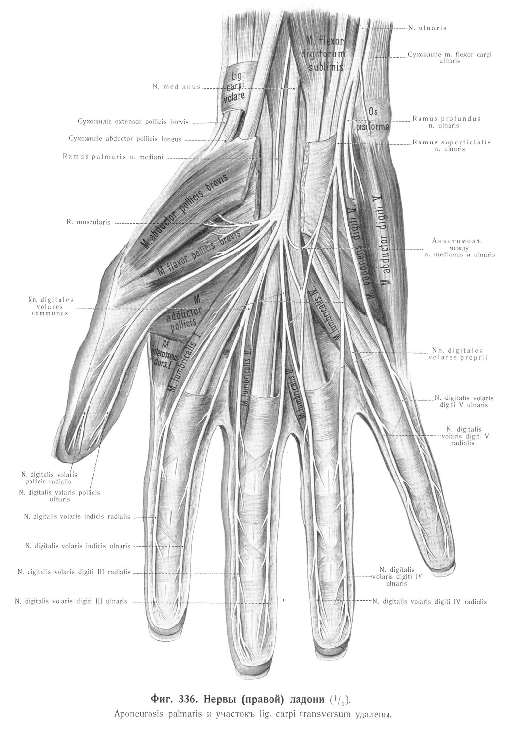 Вопросъ о дорзальныхъ нервахъ пальцевъ