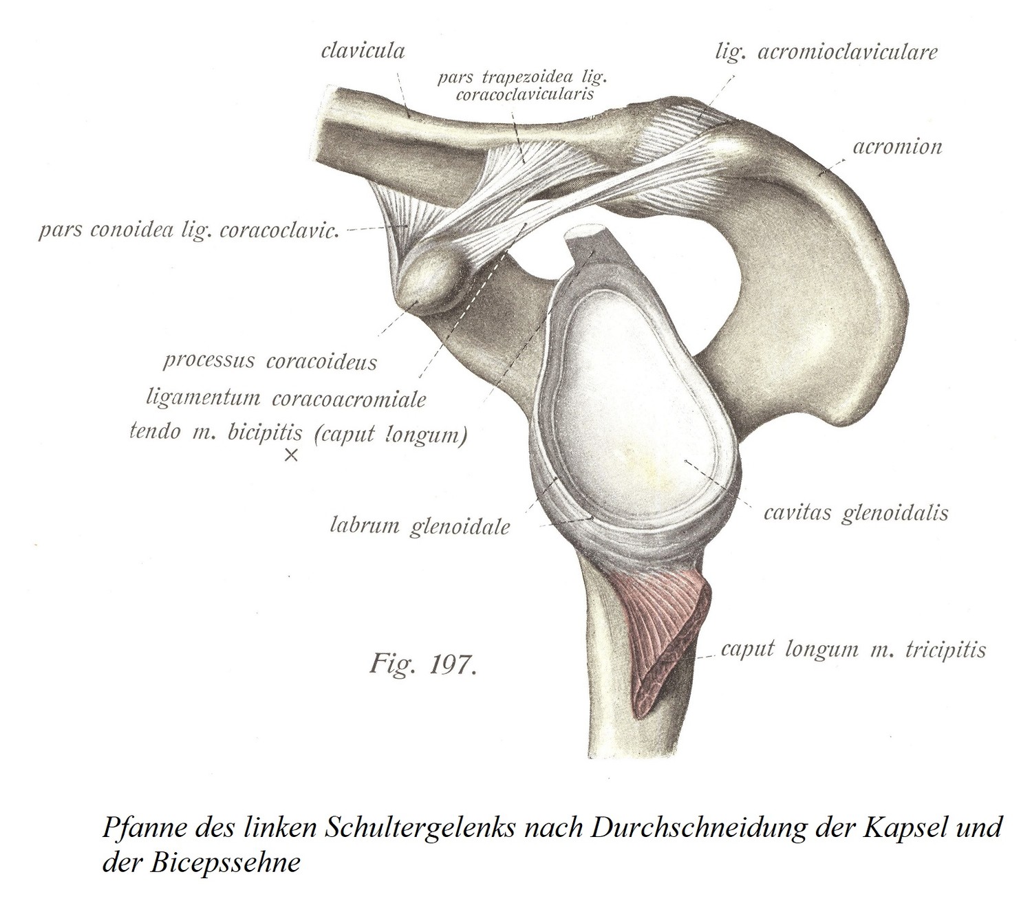 Гнездо левого плечевого сустава после рассечения капсулы и сухожилия двуглавой мышцы
