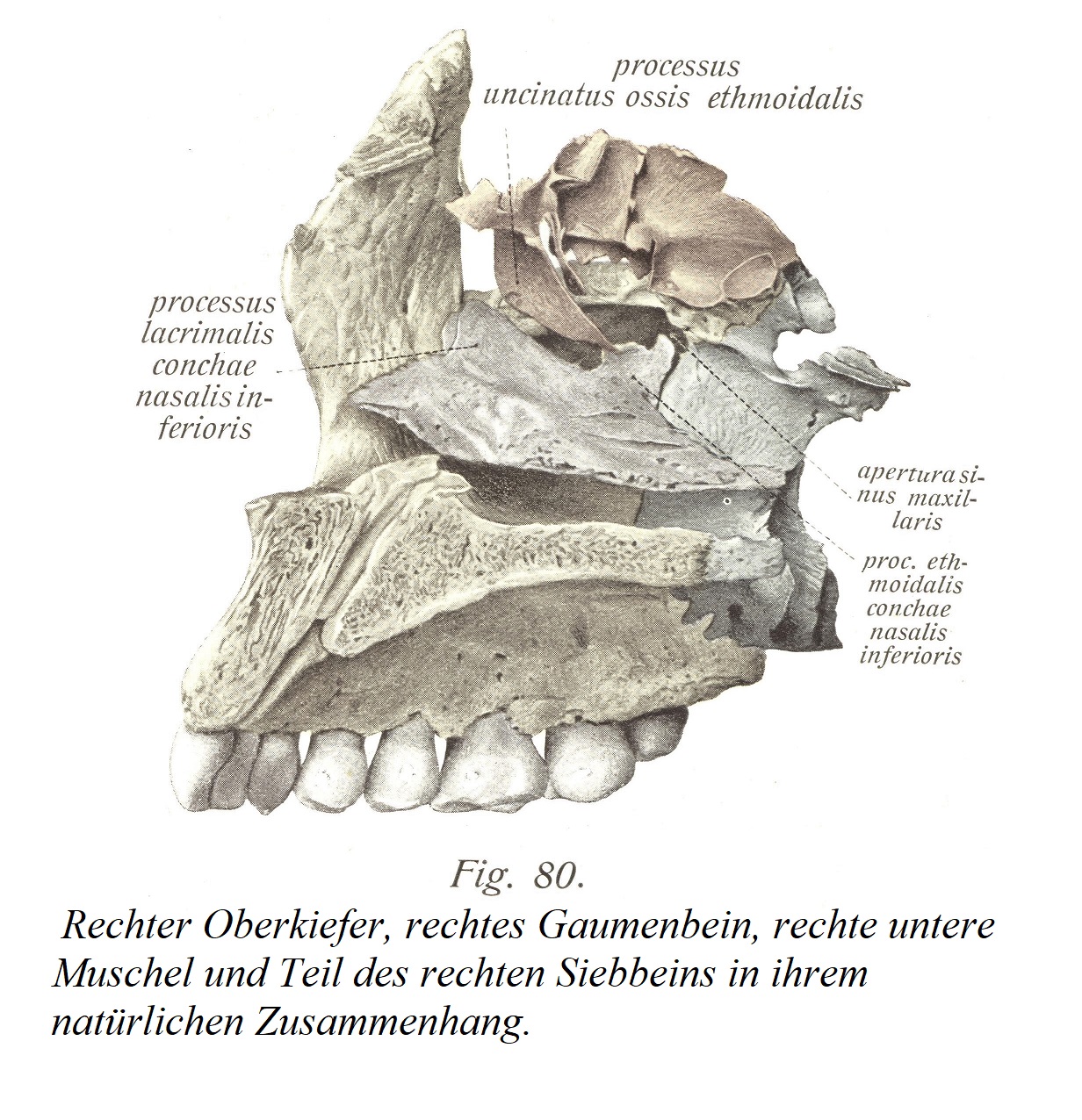 Правая верхняя челюсть, правая небная кость, правая нижняя носовая раковина и часть правой решетчатой ​​кости в их естественном соотношении.