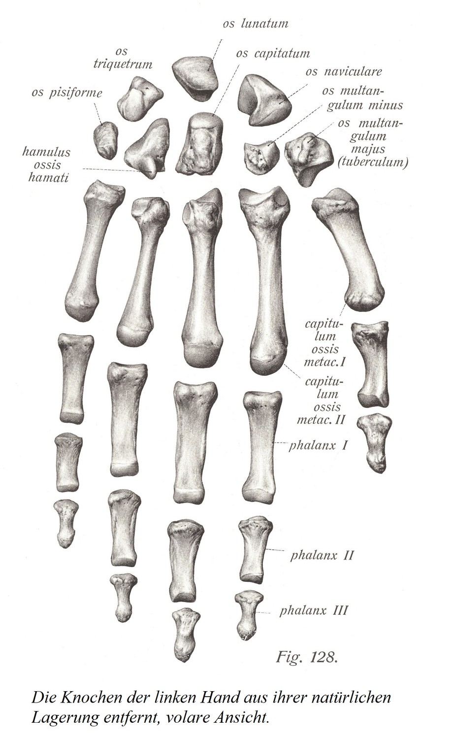 Кости левой кисти выведены из естественного положения, ладонный вид.