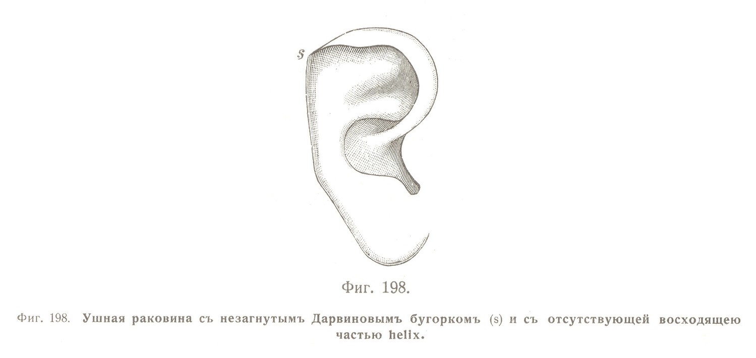 Ушная раковина съ незагнутымъ Дарвиновымъ бугоркомъ (s) и съ отсутствующей восходящею частью helix.