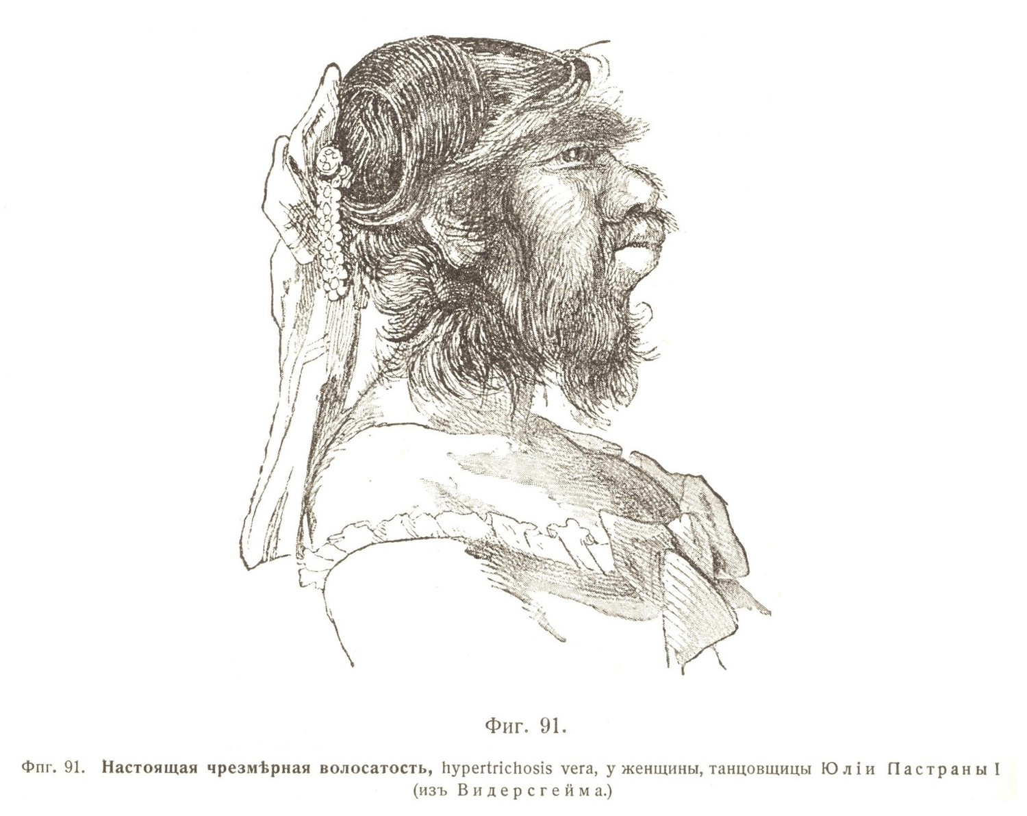 Настоящая чрезмѣрная волосатость, hypertrichosis vera, у женщины, танцовщицы Юліи Пастраны I