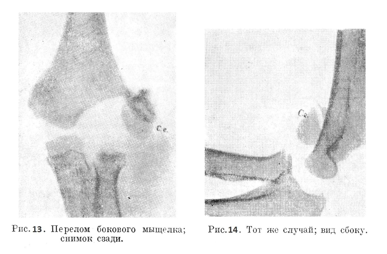 Перелом бокового мыщелка; снимок сзади и сбоку