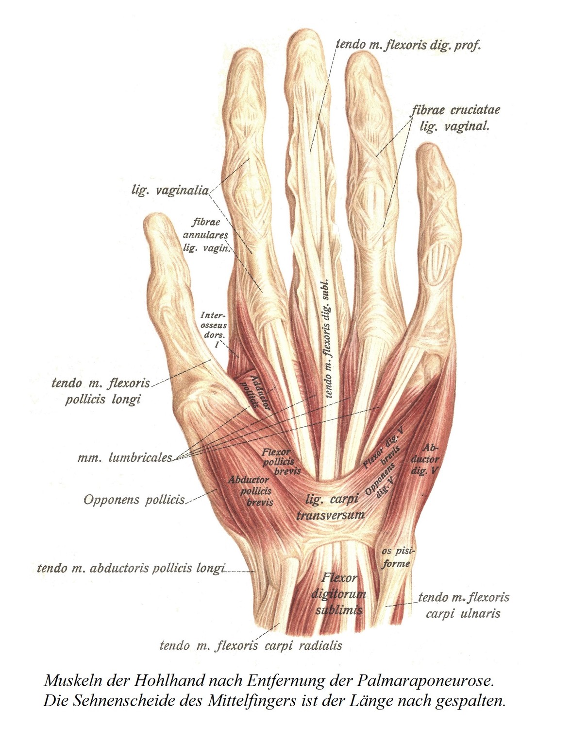 Мышцы ладони после удаления ладонного апоневроза. Сухожильное влагалище среднего пальца расщепляется вдоль.