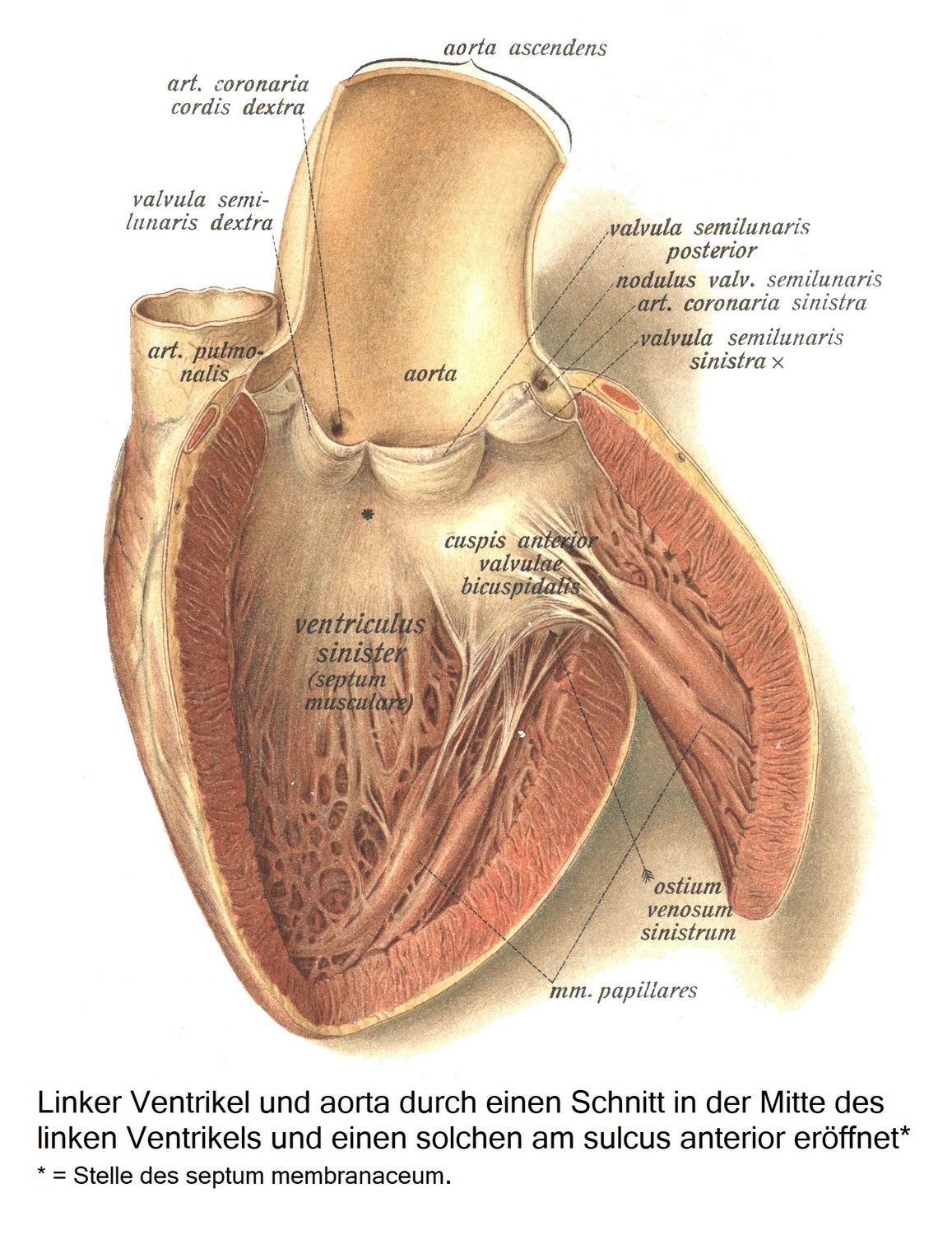 Левый желудочек и аорта вскрыты одним разрезом посередине левого желудочка и одним у передней борозды* * = расположение перепончатой ​​перегородки