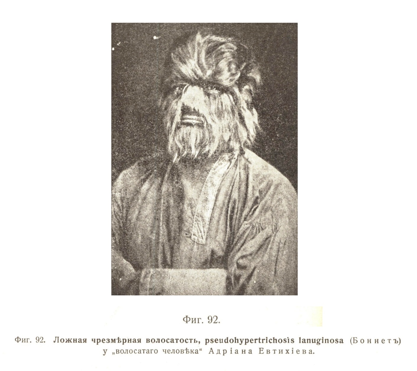Ложная чрезмѣрная волосатость, pseudohypertrichosis lanuginosa (Боннетъ) у „волосатаго человѣка' Адріана Евтихіева.