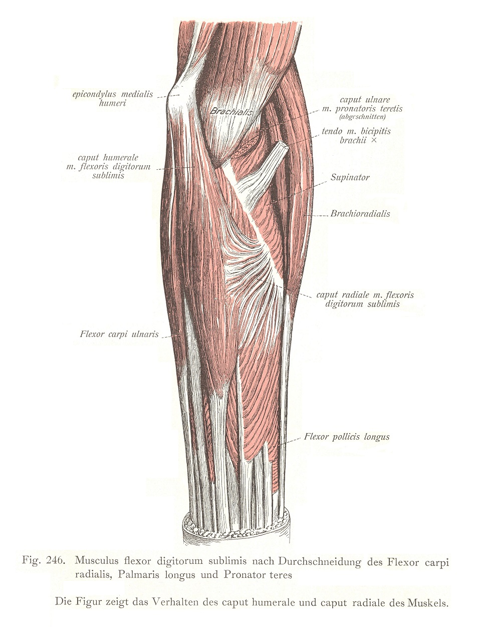Musculus flexor digitorum sublimis после рассечения лучевого сгибателя запястья, длинной ладонной мышцы и круглого пронатора. На рисунке показано поведение плечевой и лучевой головок мышцы