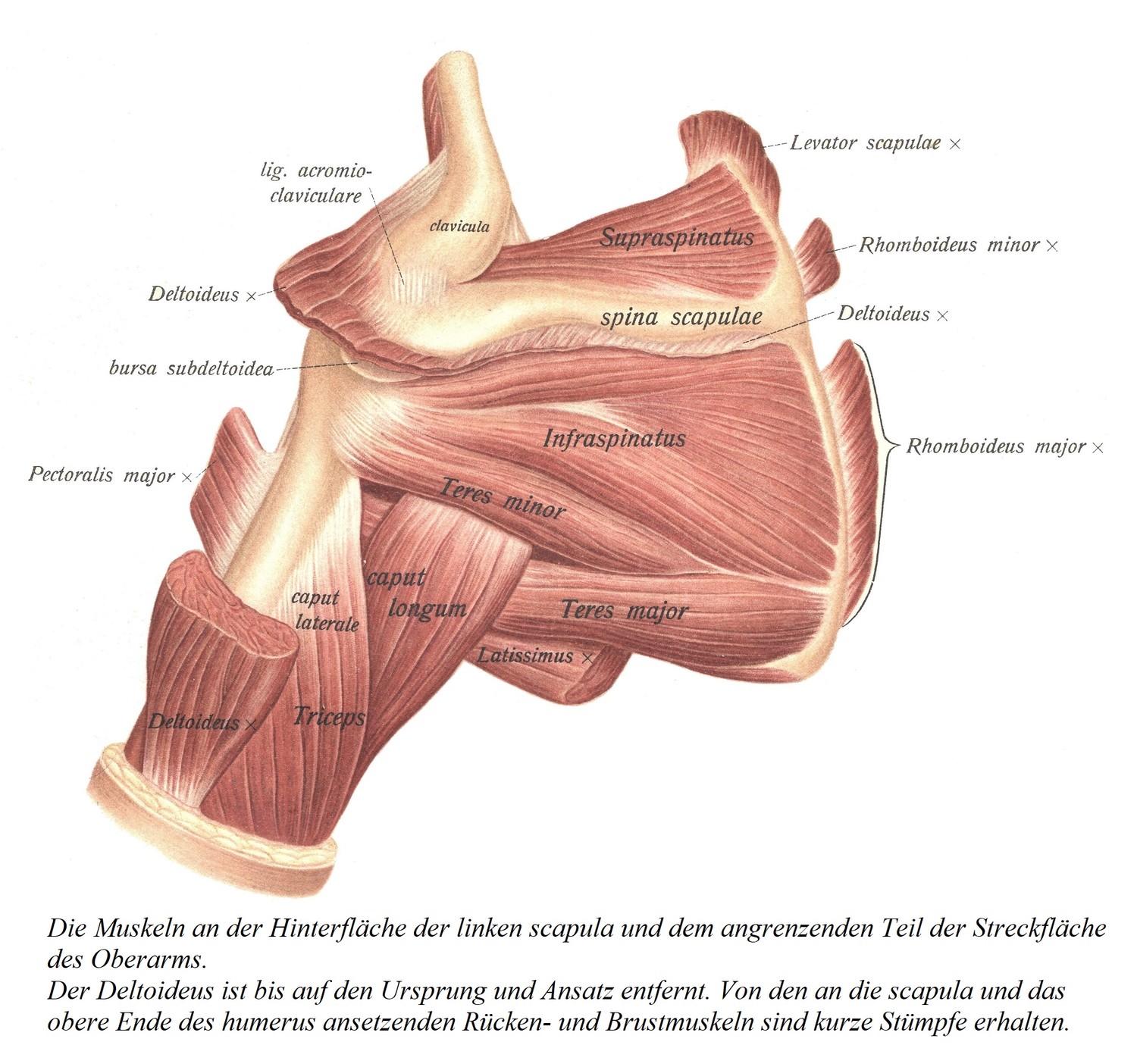 Мышцы задней поверхности левой лопатки и прилежащего участка разгибательной поверхности плечевой кости. Дельтовидная мышца удаляется, за исключением начала и вставки. Сохранены короткие культи тыльной и грудной мышц, прикрепляющиеся к лопатке и верхнему концу плечевой кости.