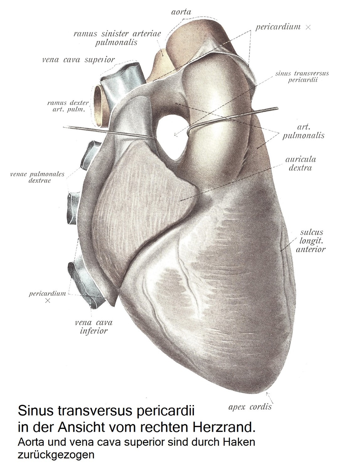 Sinus transversus pericardii при осмотре от правого края сердца. Аорту и верхнюю полую вену отводят крючками