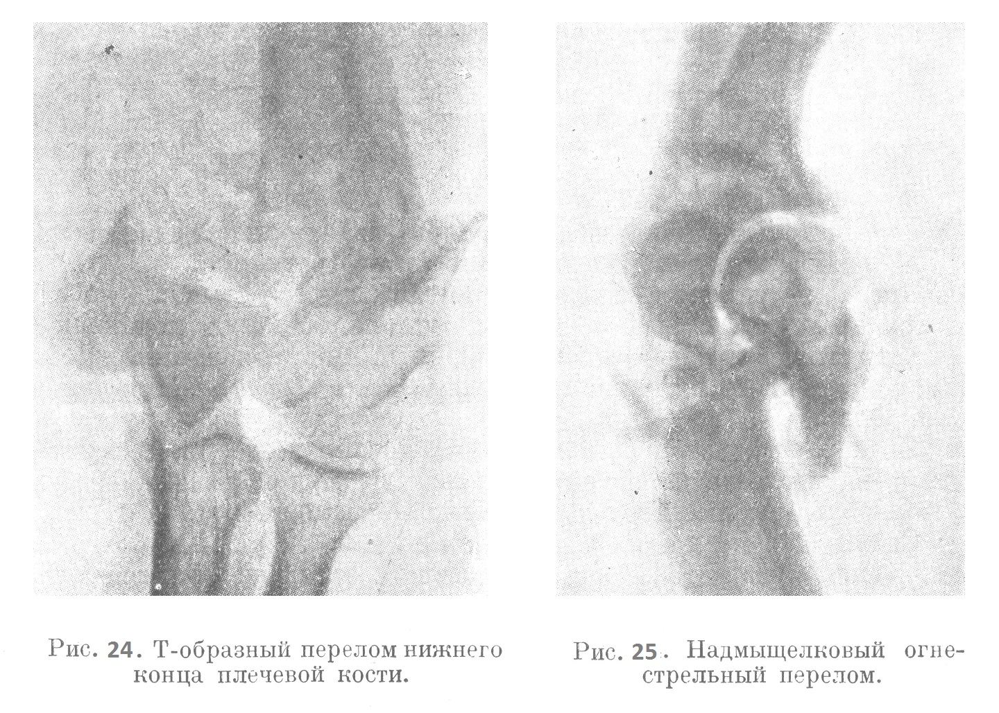Т-образный перелом нижнего конца плечевой кости. Надмыщелковый огнестрельный перелом