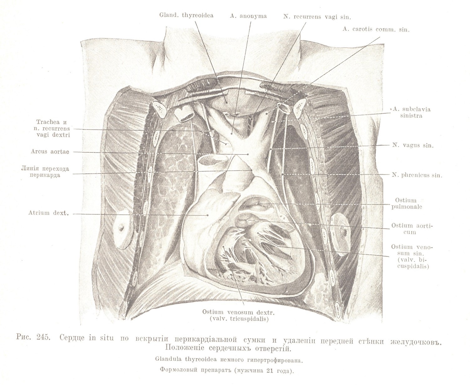 Сердце in situ по вскрытіи перикардіальной сумки и удаленіи передней стѣнки желудочковъ. Положеніе сердечныхъ отверстій.