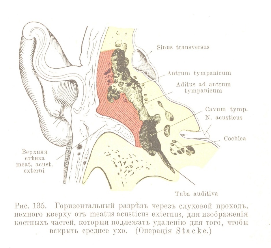 Горизонтальный разрѣзъ черезъ слуховой проходъ, немного кверху отъ meatus acusticus externus, для изображенія костныхъ частей, которыя подлежатъ удаленію для того, чтобы вскрыть среднее ухо. (Операція Stacke.)