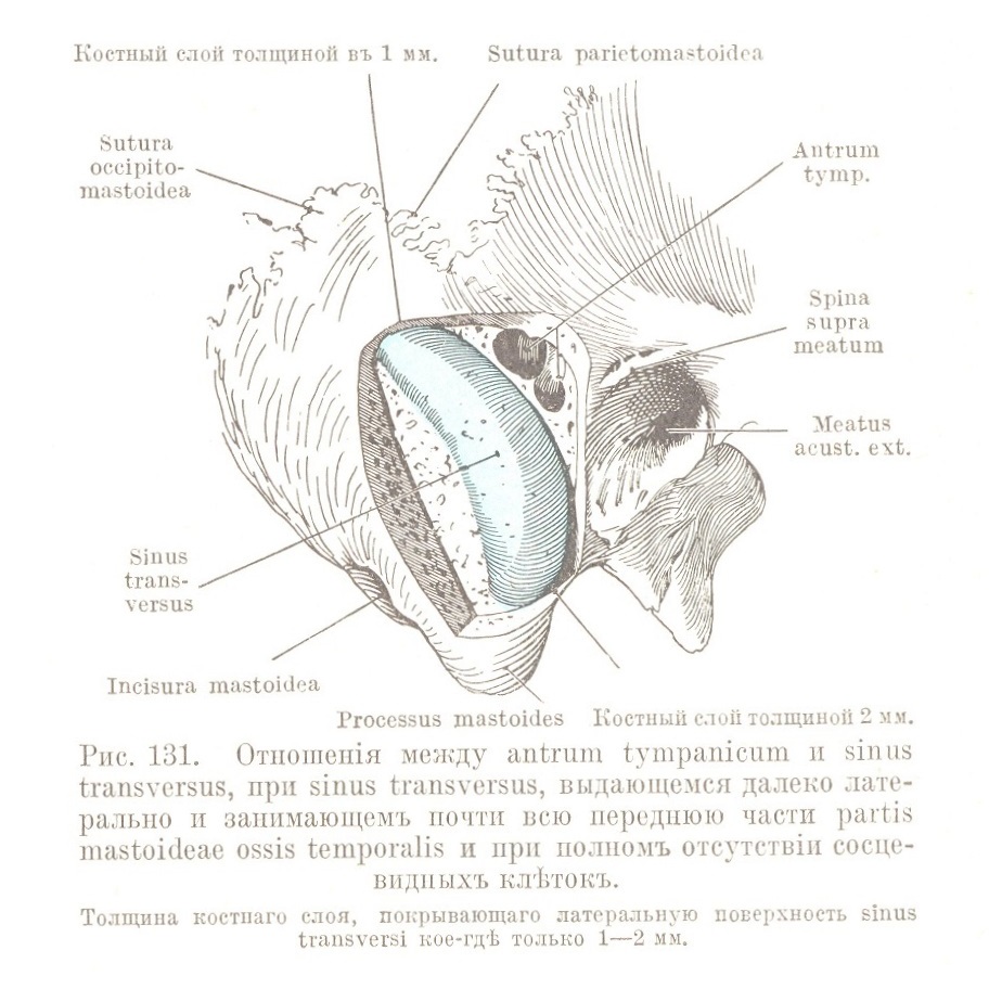 Отношенія между antrum tympanicum и sinus transversus, при sinus transversus, выдающемся далеко лате- рально и занимающемъ почти всю переднюю части partis mastoideae ossis temporalis и при полномъ отсутствіи сосцевидныхъ клѣтокъ. Толщина костнаго слоя, покрывающаго латеральную поверхность sinus transversi кое-гдѣ только 1—2 мм.