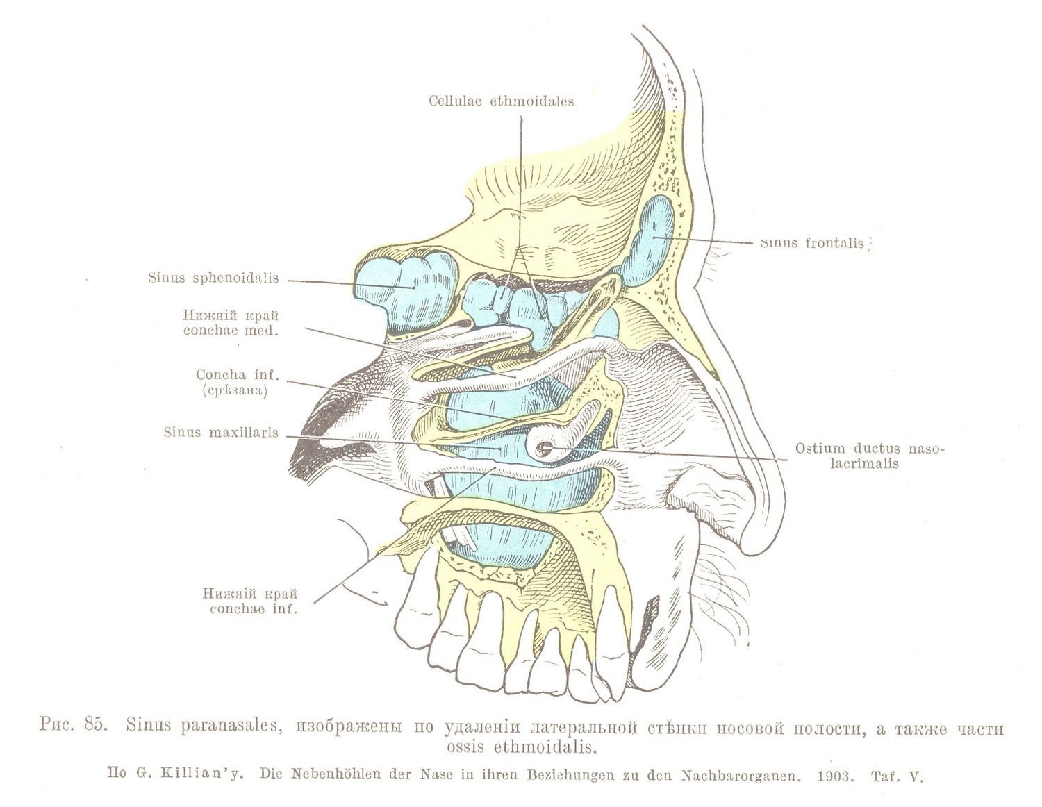 Sinus paranasales, изображены по удаленіи латеральной стѣнки носовой полости, а также части
