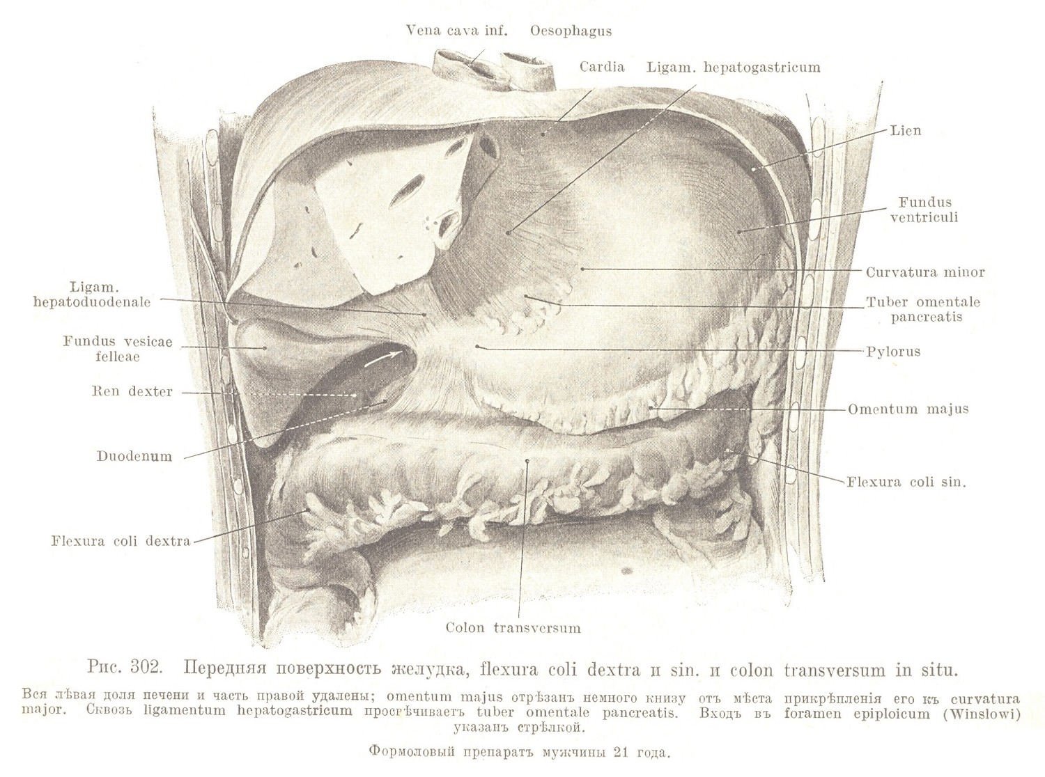 Передняя поверхность желудка, flexura coli dextra и sin. и colon transversum in situ.