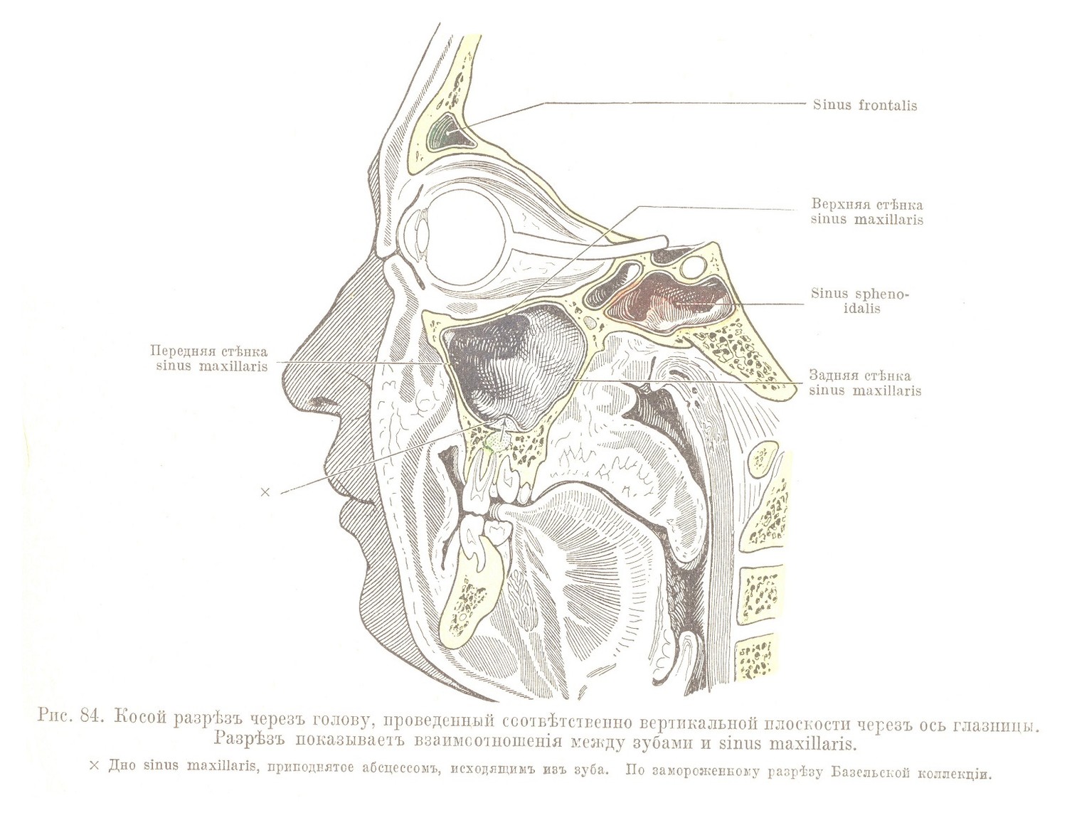 Косой разрѣзъ черезъ голову, проведенный соотвѣтственно вертикальной плоскости черезъ ось глазницы. Разрѣзъ показываетъ взаимоотношенія между зубами и sinus maxillaris.