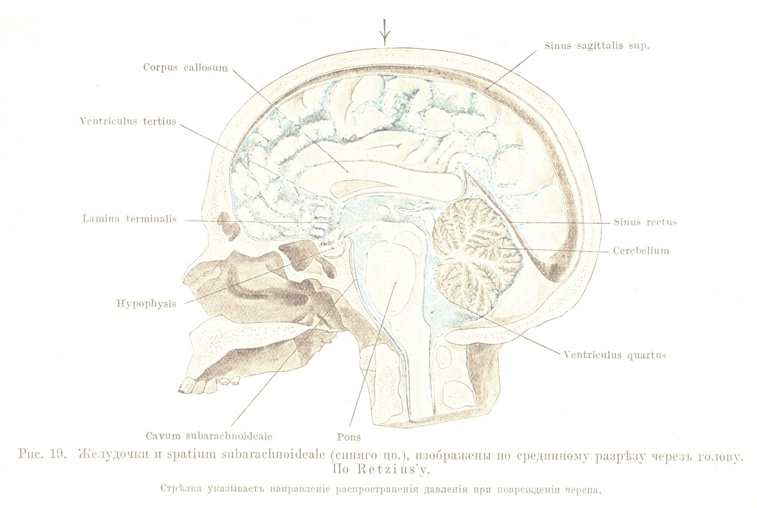 Желудочки и spatium subarachnoideale (синяго цв.), изображены по срединному разрѣзу черезъ голову. По Retzius’v. Стрѣлка указываетъ направленіе распространенія давленія при поврежденіи черепа.