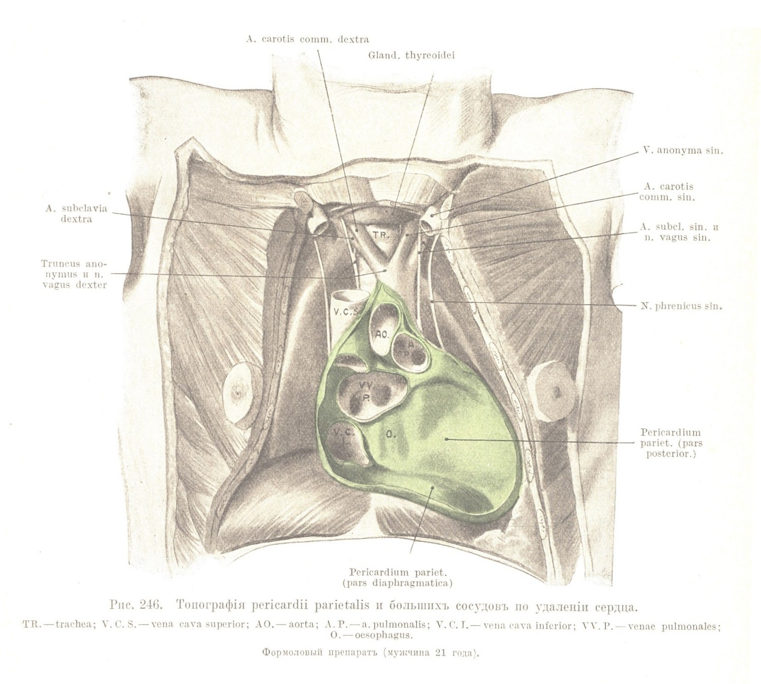 Топографія pericardii parietalis и большихъ сосудовъ по удаленіи сердца