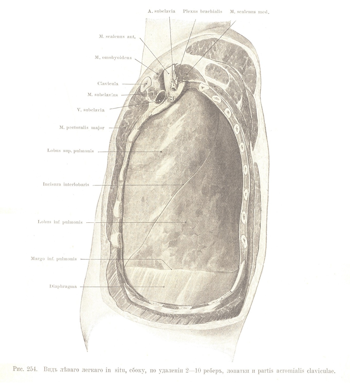 Видъ лѣваго легкаго in situ, сбоку, по удаленіи 2—10 реберъ, лопатки и partis acromialis claviculae.