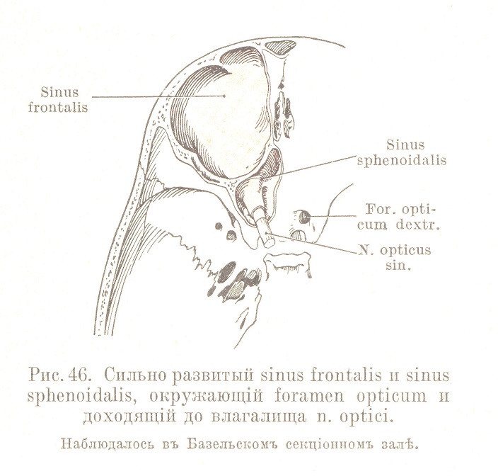 Сильно развитый sinus frontalis и sinus sphenoidalis, окружающій foramen opticum и доходящій до влагалища n. optici.