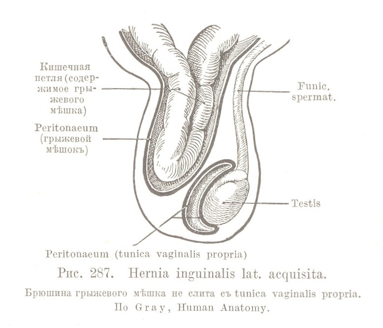 Hernia inguinalis lat. acquisita.