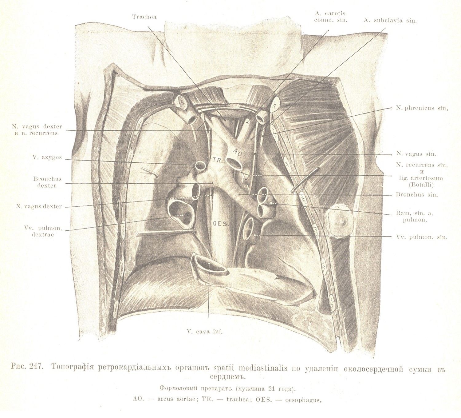 Топографія ретрокардіальныхъ органовъ spatii mediastinalis по удаленіи околосердечной сумки съ сердцемъ.
