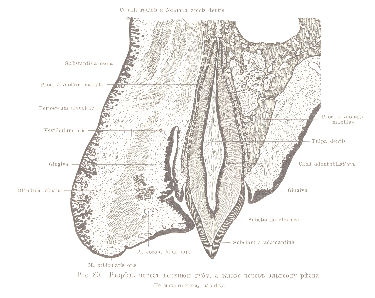 Разрѣзъ черезъ верхнюю губу, а также черезъ альвеолу рѣзца.