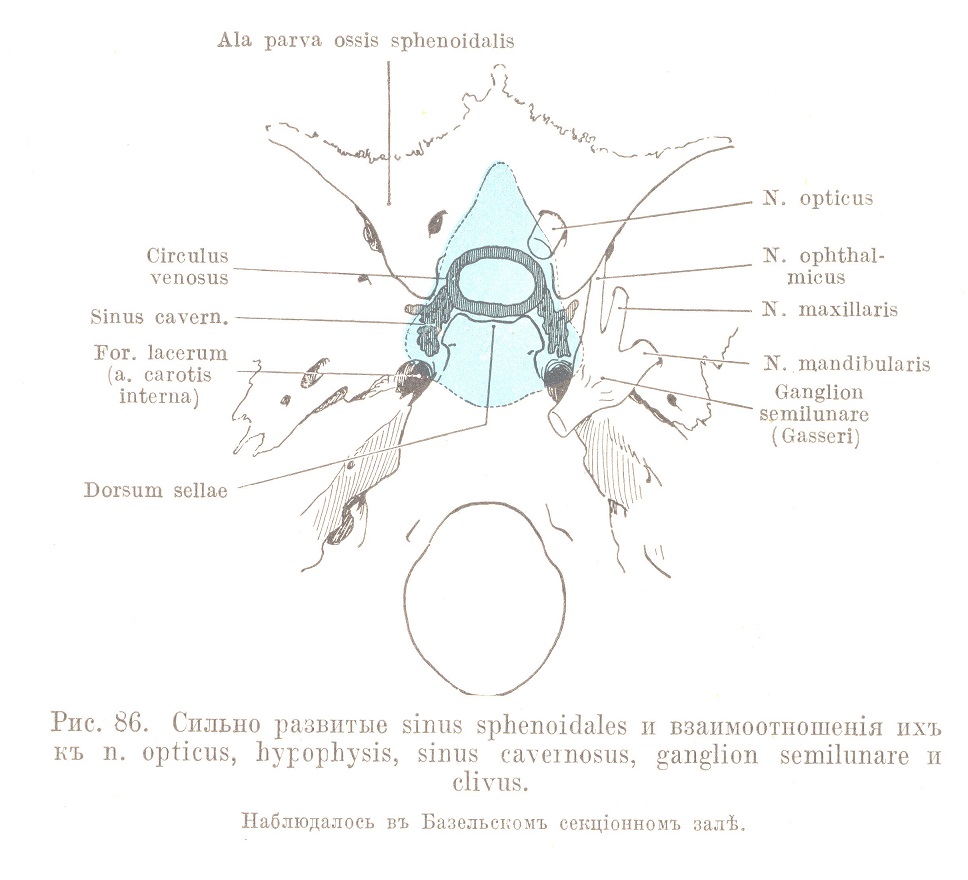 Сильно развитые sinus sphenoidales и взаимоотношенія ихъ къ n. opticus, hypophysis, sinus cavernosus, ganglion semilunare и clivus.