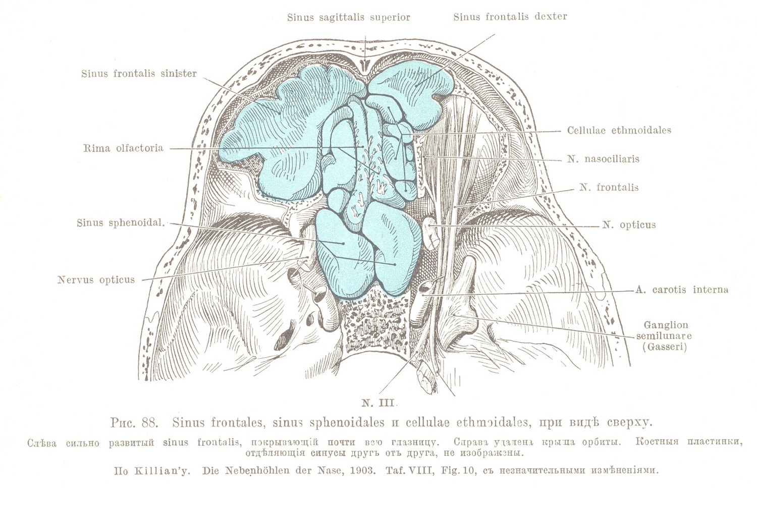 Sinus frontales, sinus sphenoidales и cellulae ethmoidales, при видѣ сверху. Слѣва сильно развитый sinus frontalis, покрывающій почти всю глазницу. Справа удалена крыла орбиты. Костныя пластинки, отдѣляющія синусы другъ отъ друга, не изображены.