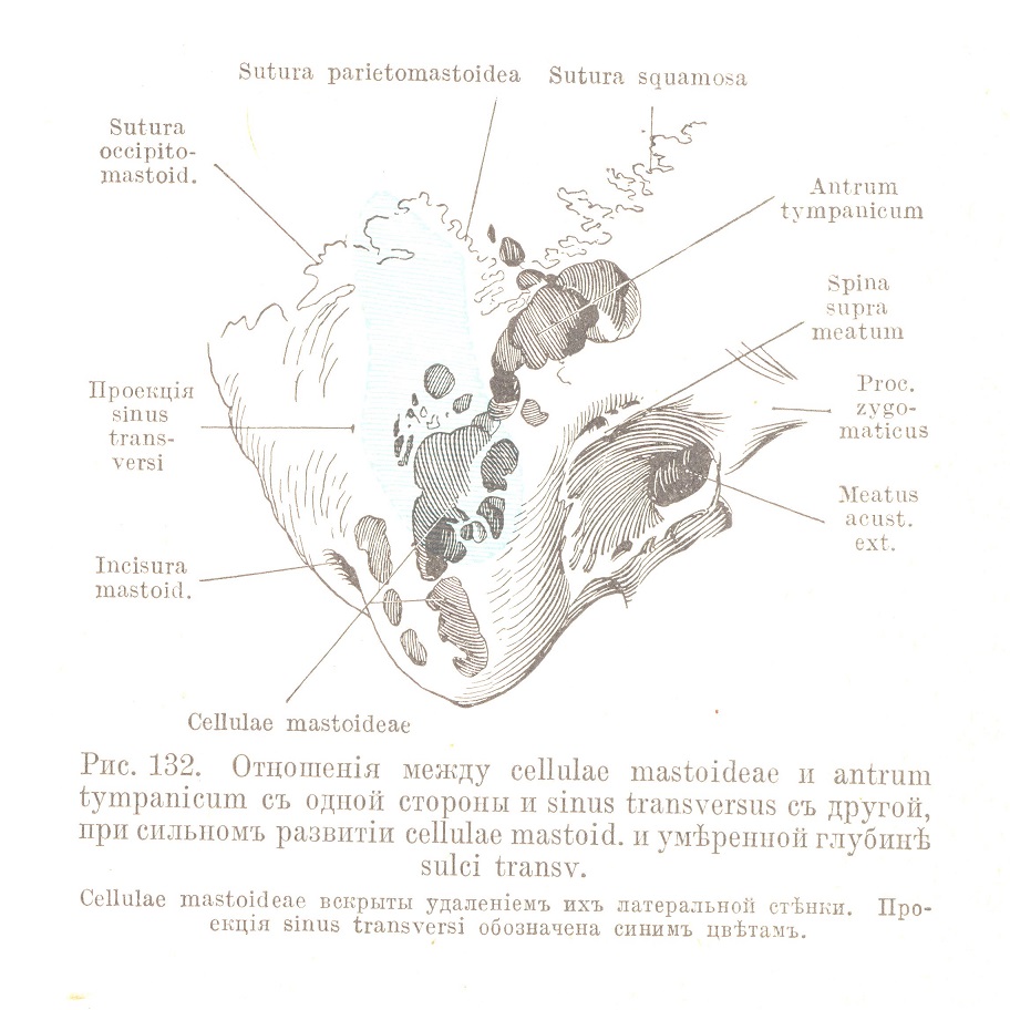 Отношенія между cellulae mastoideae и antrum tympanicum съ одной стороны и sinus transversus съ другой,