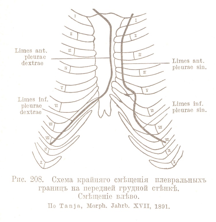 Схема крайняго смѣщенія плевральныхъ границъ на передней грудной стѣнкѣ. Смѣщеніе влѣво.