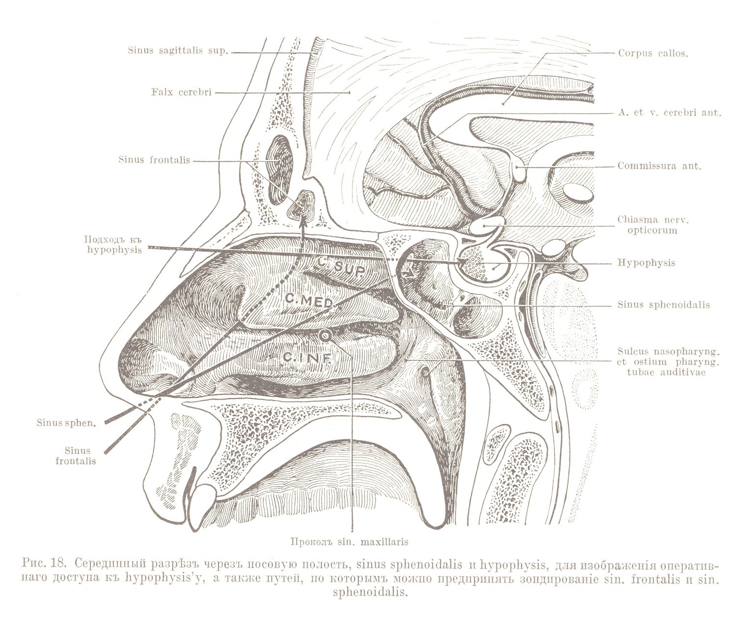 Серединный разрѣзъ черезъ носовую полость, sinus sphenoidalis и hypophysis, для изображенія оперативнаго доступа къ hypophysis’y, а также путей, по которымъ можно предпринять зондированіе sin. frontalis и sin. sphenoidalis.