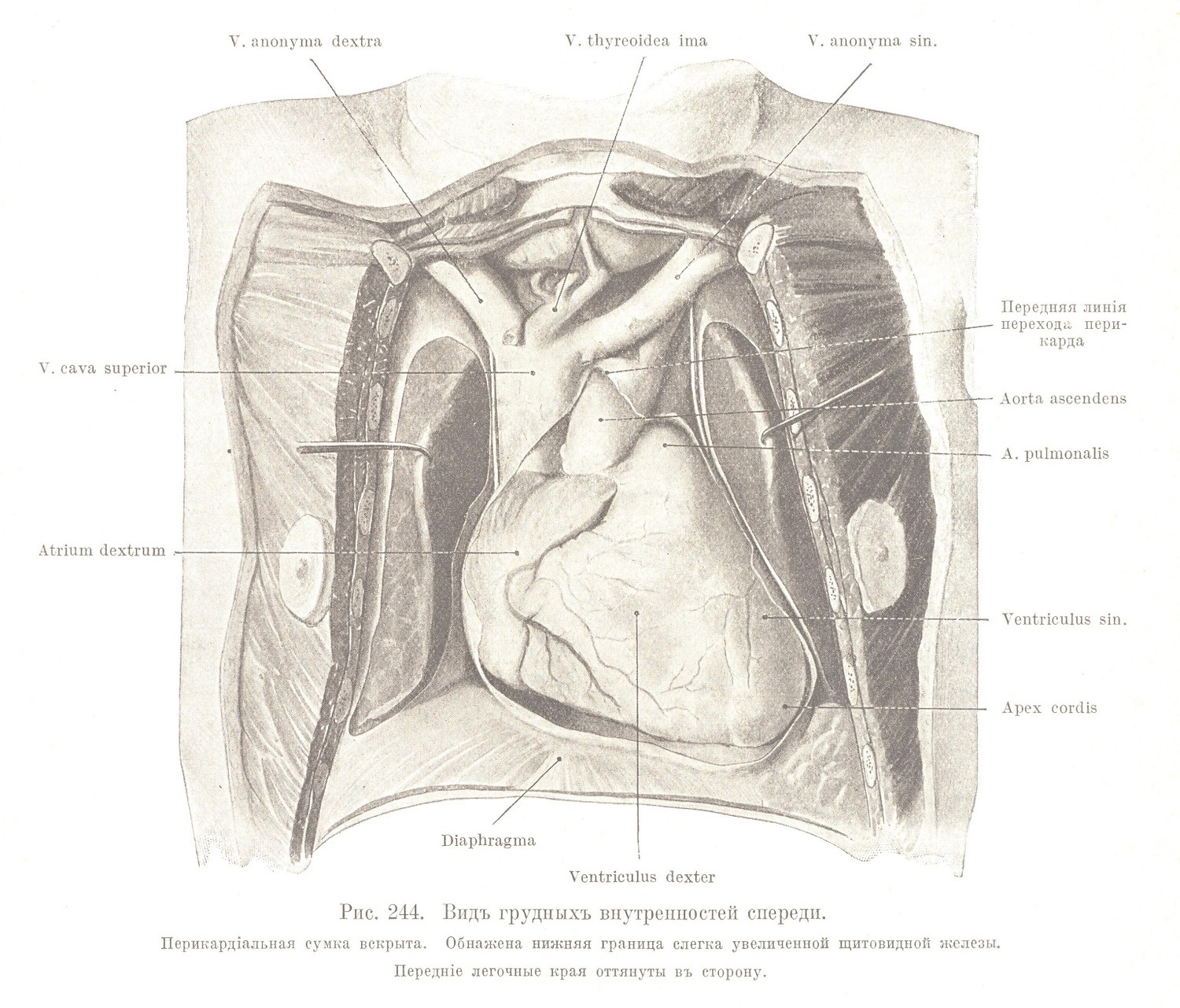 Видъ грудныхъ внутренностей спереди. Перикардіальная сумка вскрыта. Обнажена нижняя граница слегка увеличенной щитовидной железы. 