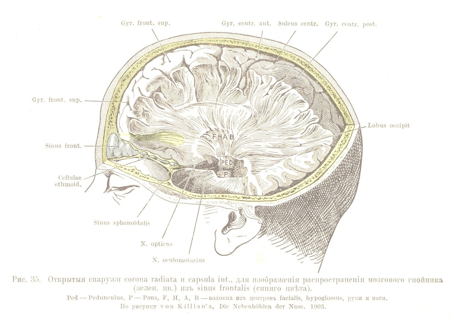 Открытыя снаружи corona radiata и capsula int., для изображенія распространенія мозгового гнойника (зелен, дв.) изъ sinus frontalis (синяго цвѣта).