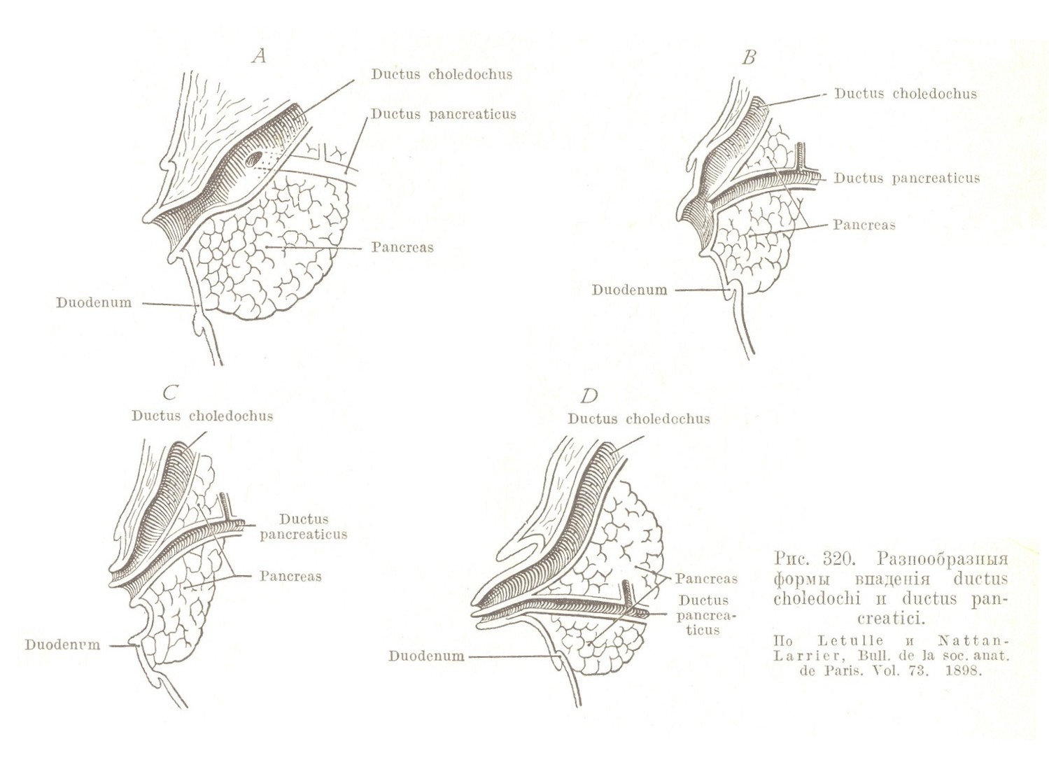 Разнообразныя формы впаденія ductus choledochi и ductus pancreatici.