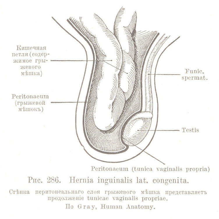 Hernia inguinalis lat. congenita. Стѣнка перитонеальнаго слоя грыжевого мѣшка представляетъ продолженіе tunicae vaginalis propriae.