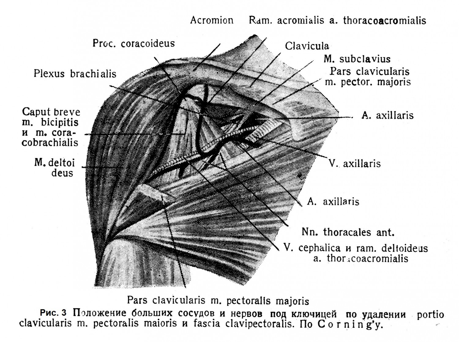  В области этого треугольника из-под средины ключицы выходит plexus brachialis