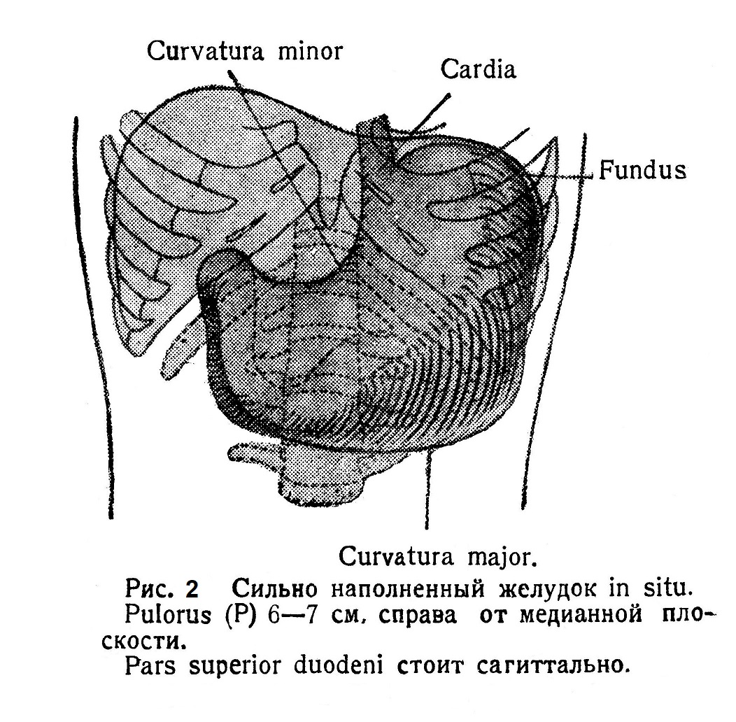 Сильно наполненный желудок in situ. Bulorus (Р) 6—7 см. справа от медианной плоскости. Pars superior duodeni стоит сагиттально.